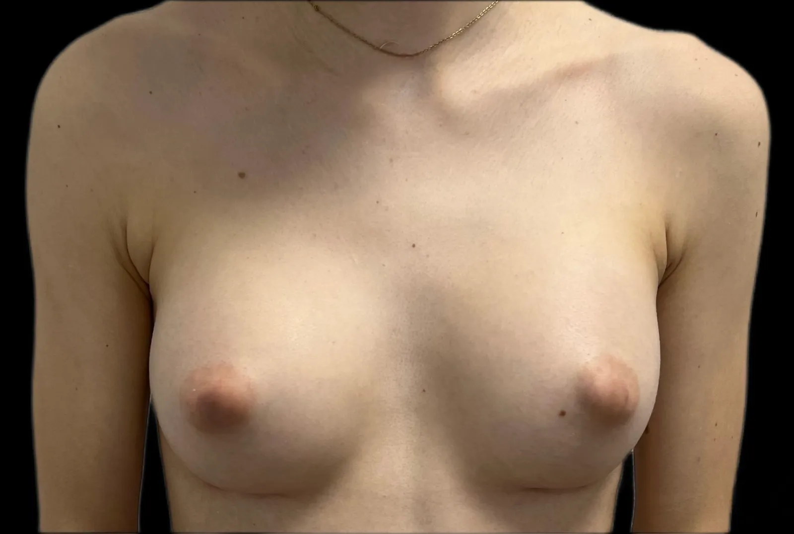 Poitrine d'une patiente de face, avant et après une augmentation mammaire par prothèses — après