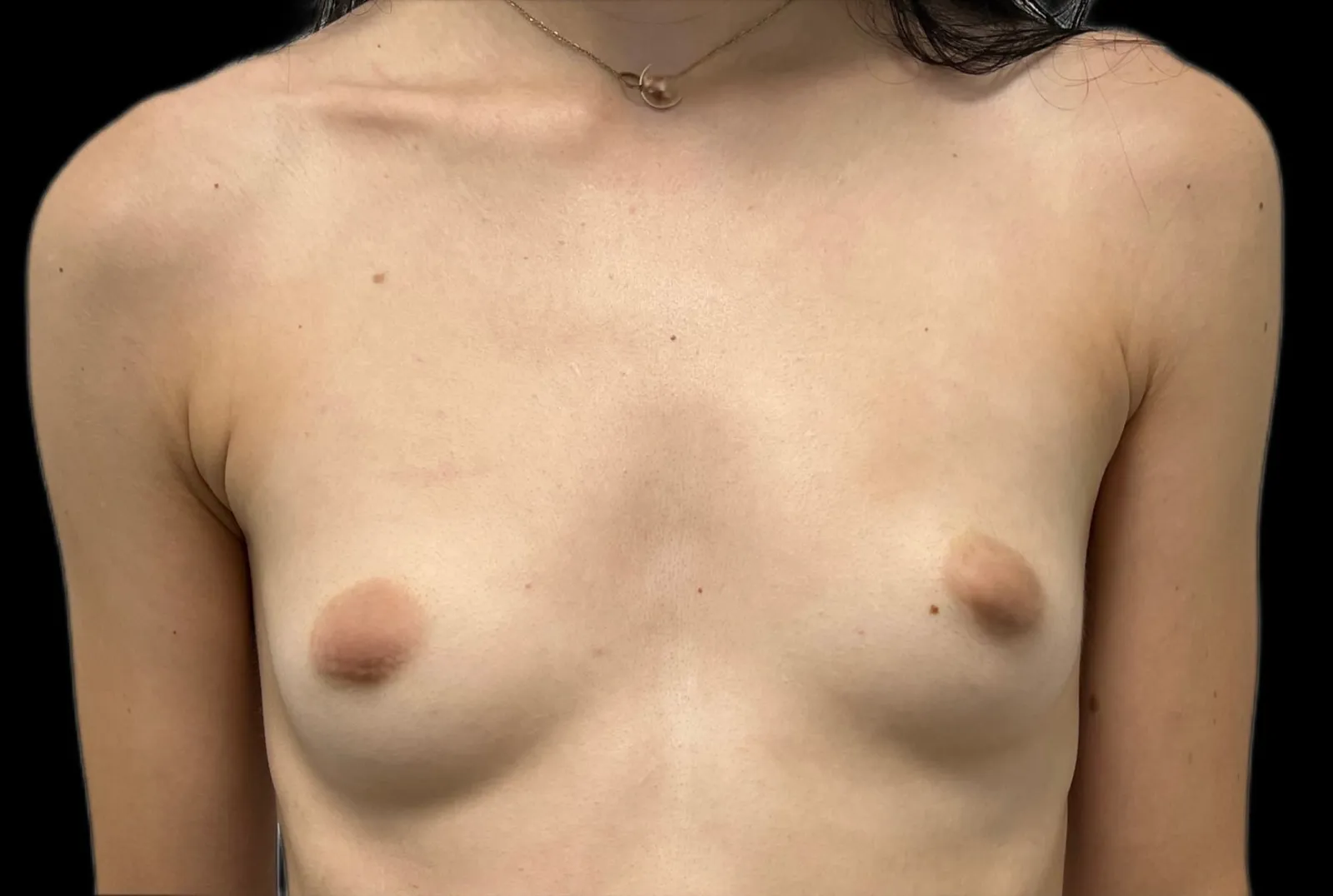 Poitrine d'une patiente de face, avant et après une augmentation mammaire par prothèses — avant