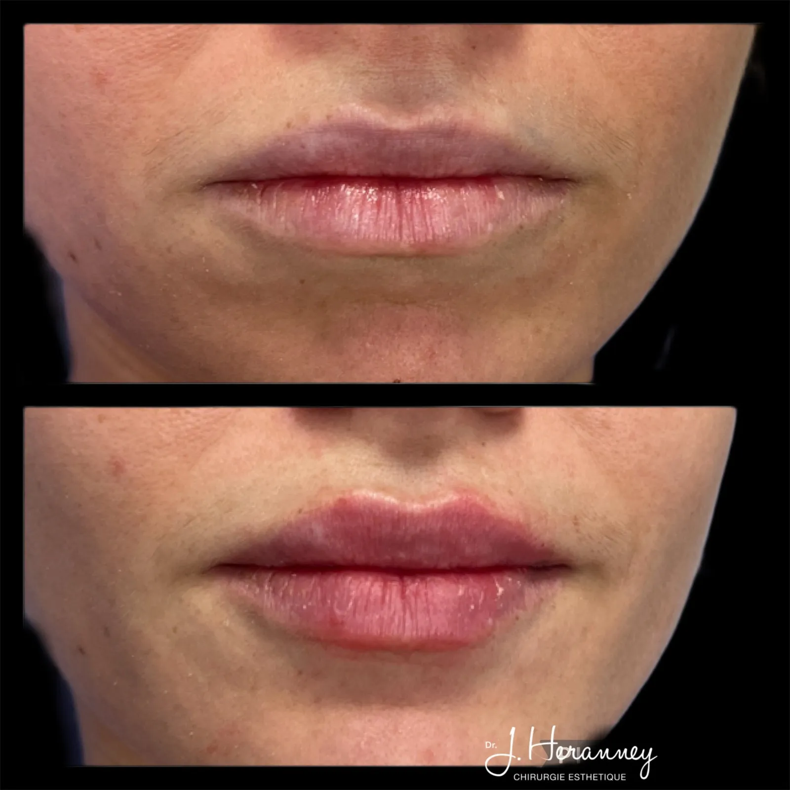 Acide hyaluronique par le Dr Julie Heranney — avant et après, cliché 8