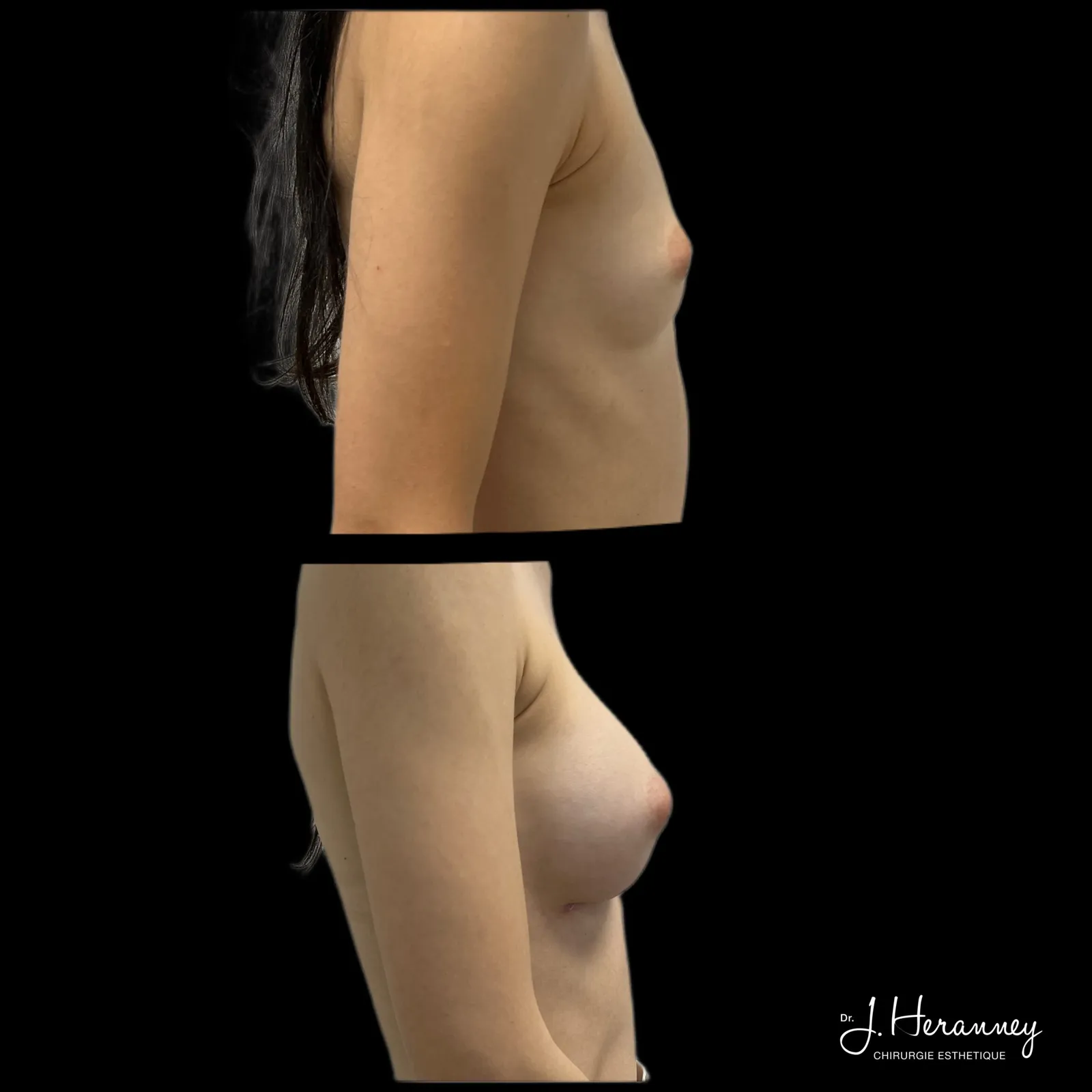 Augmentation mammaire par prothèses par le Dr Julie Heranney — avant et après, cliché 1