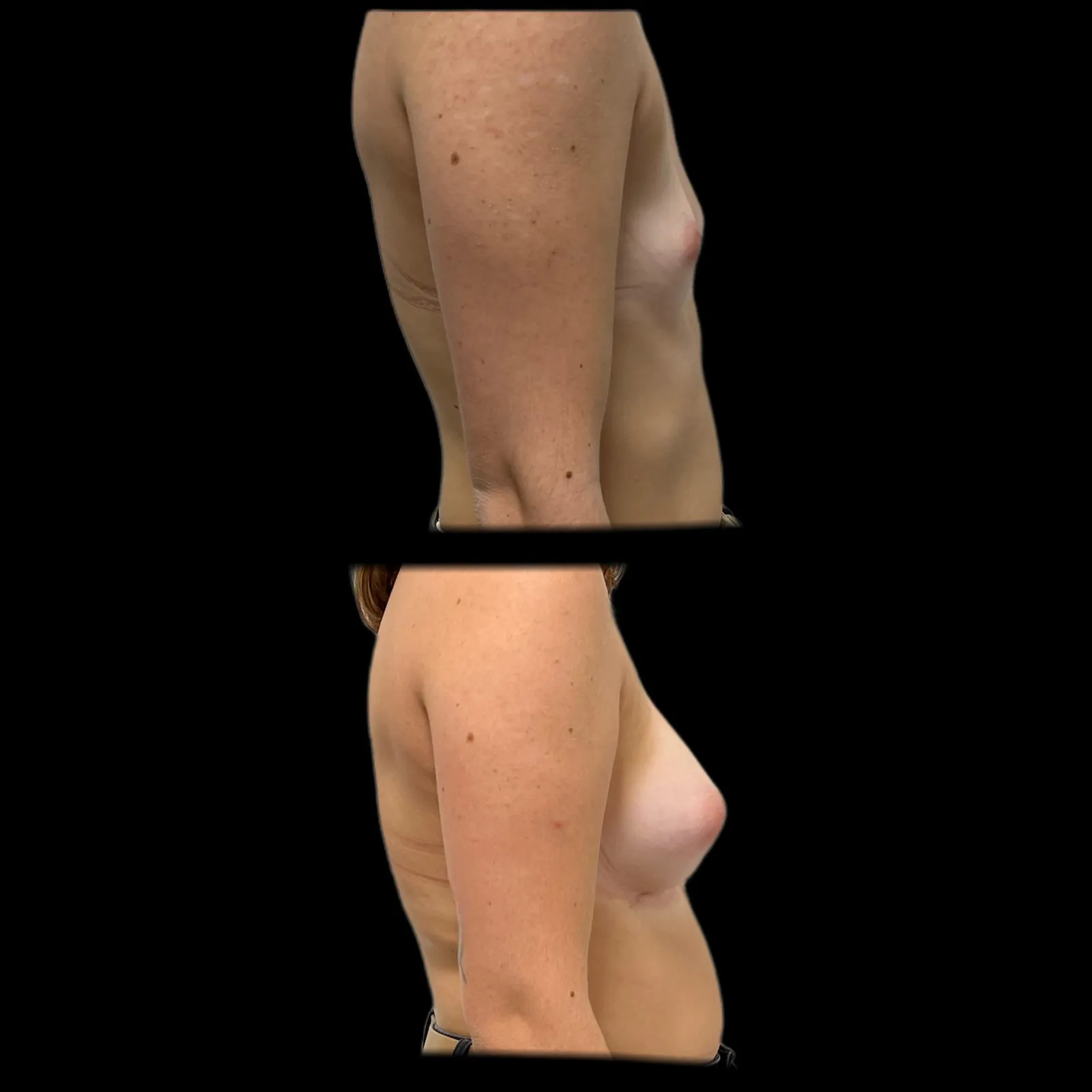 Augmentation mammaire par prothèses par le Dr Julie Heranney — avant et après, cliché 10