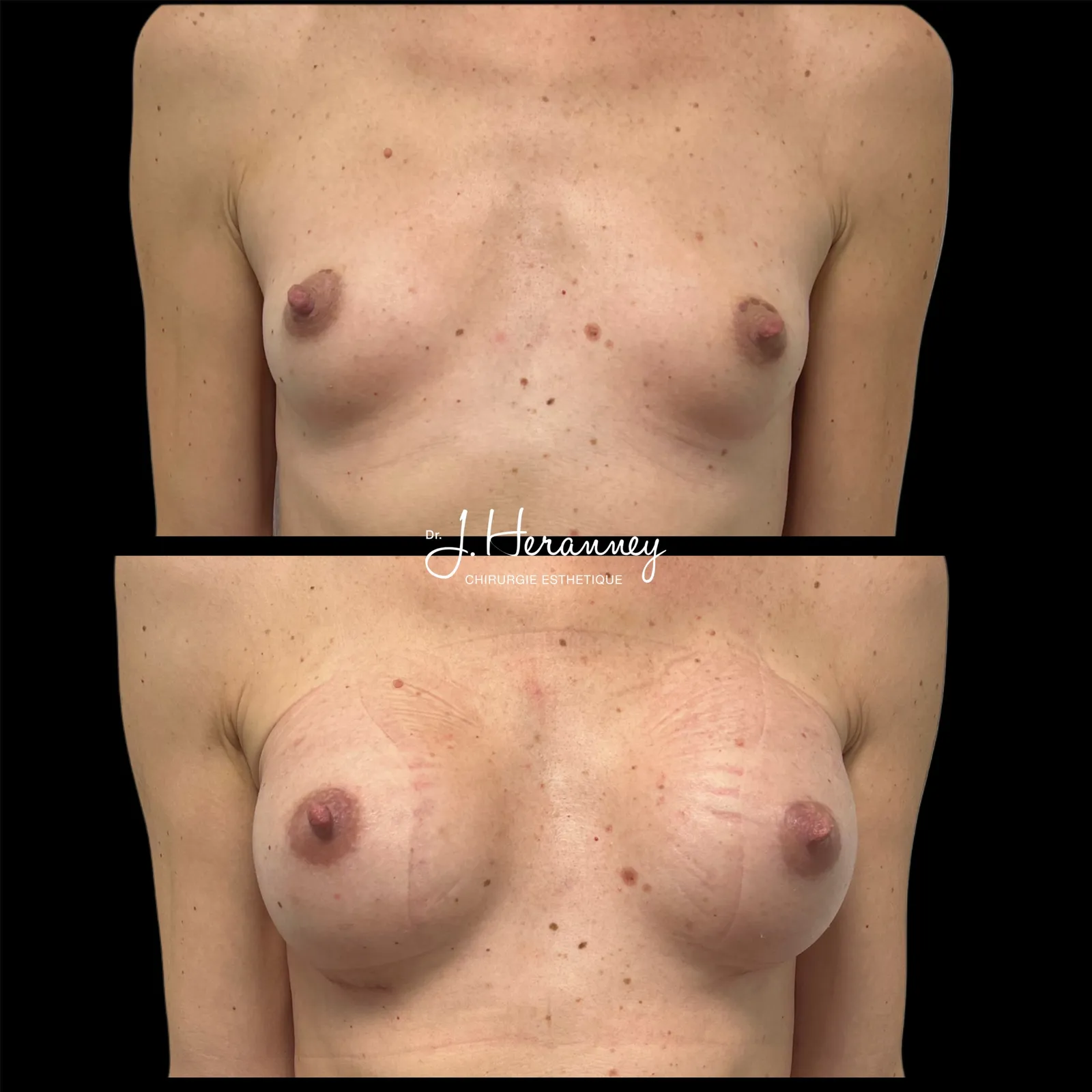 Augmentation mammaire par prothèses par le Dr Julie Heranney — avant et après, cliché 11