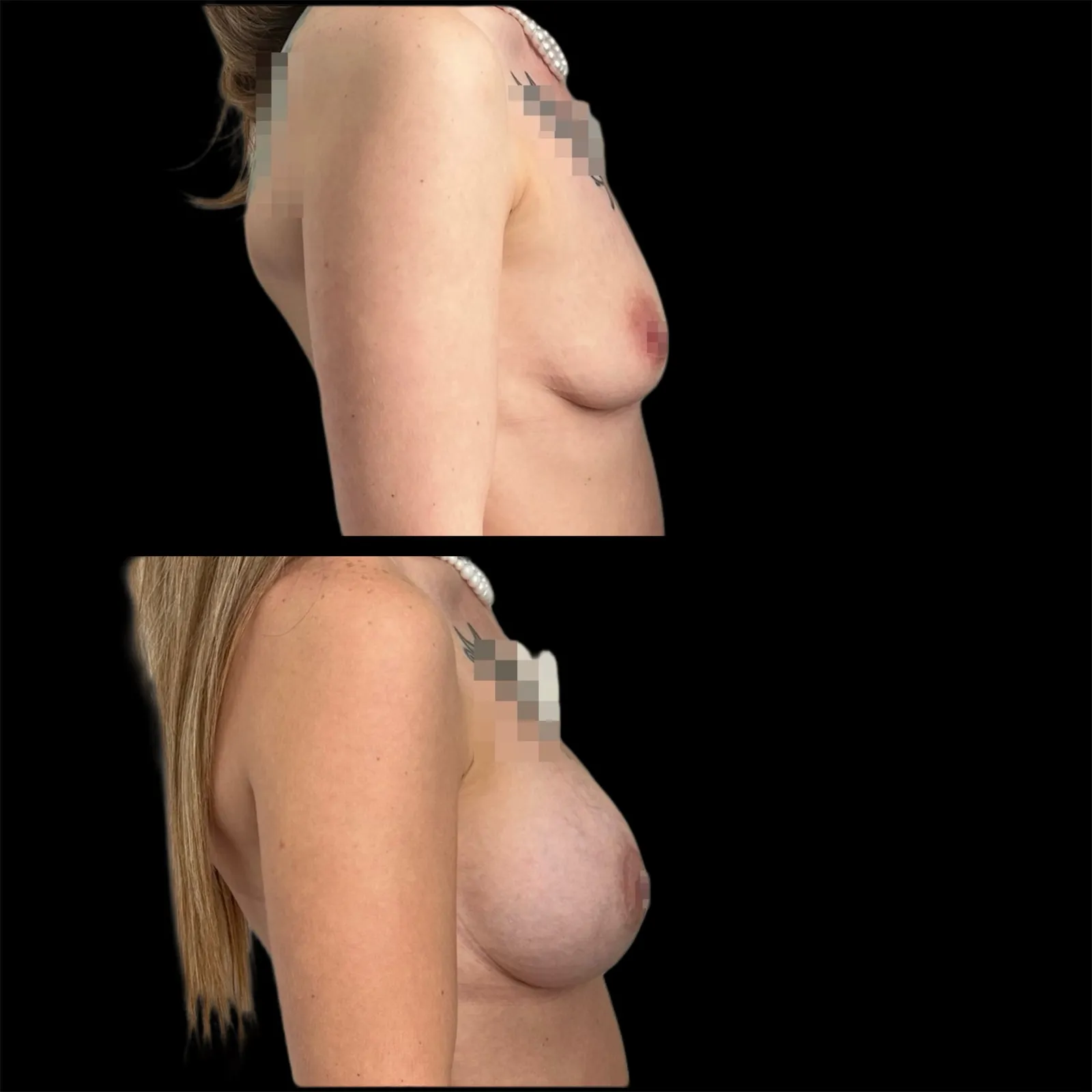 Augmentation mammaire par prothèses par le Dr Julie Heranney — avant et après, cliché 14