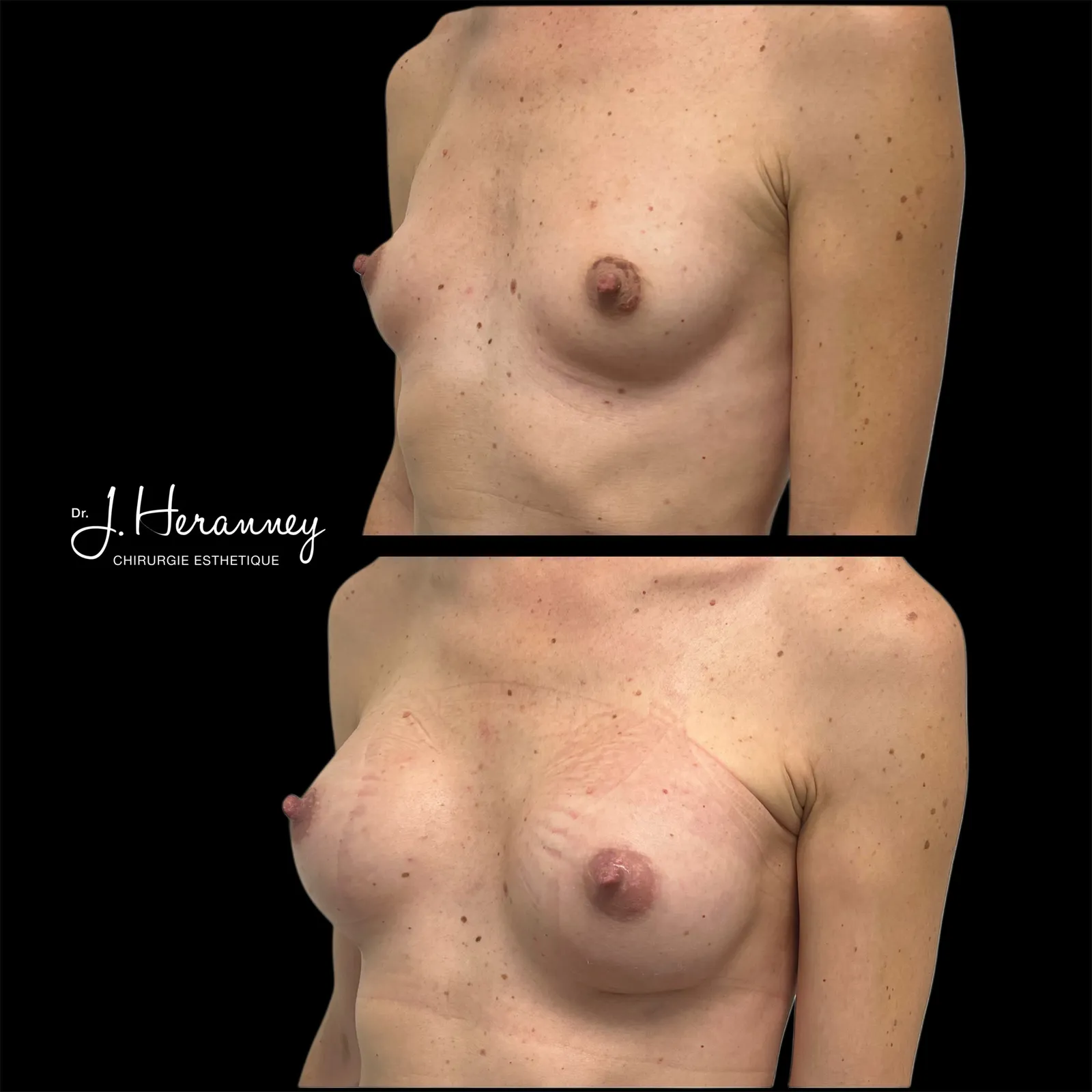 Augmentation mammaire par prothèses par le Dr Julie Heranney — avant et après, cliché 15