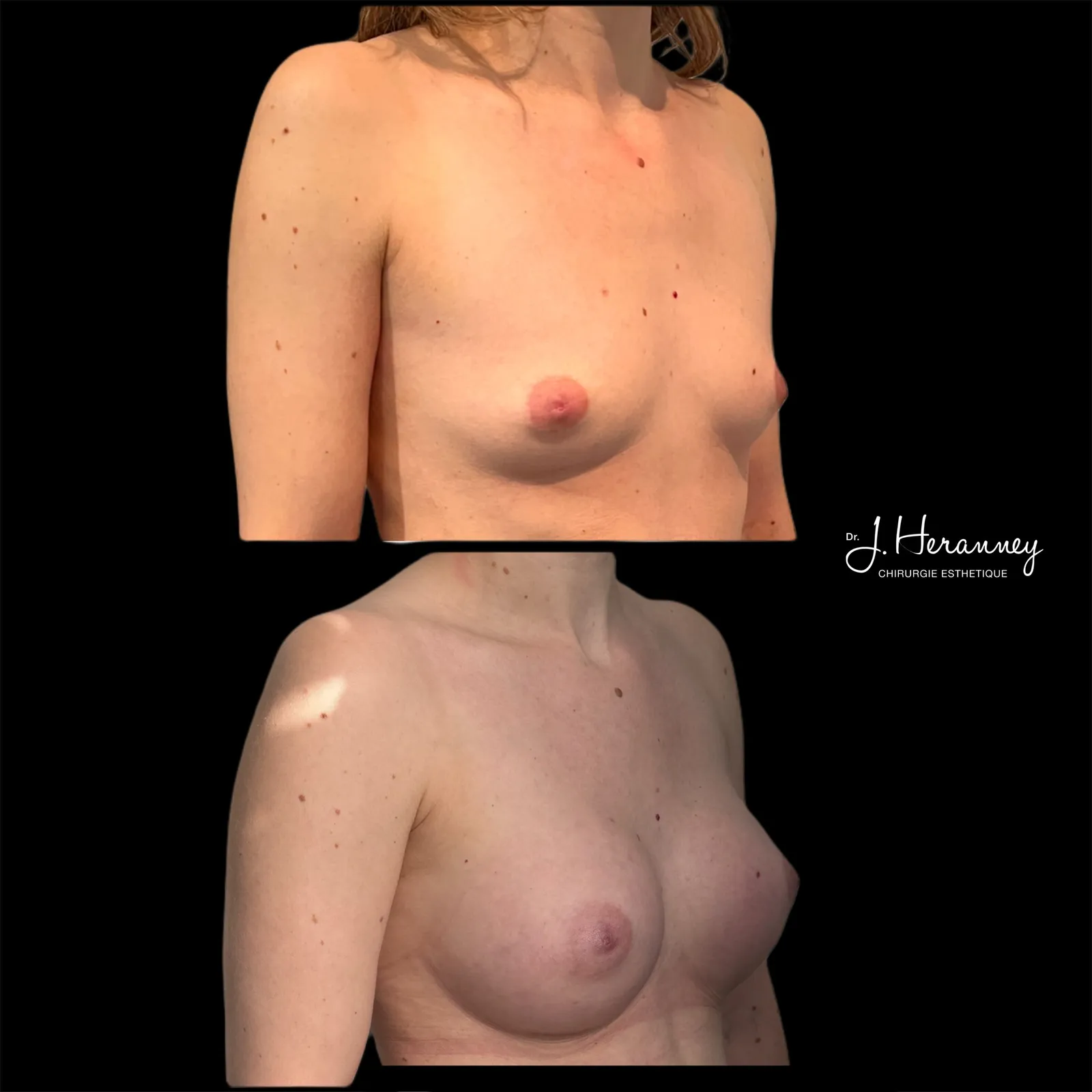 Augmentation mammaire par prothèses par le Dr Julie Heranney — avant et après, cliché 16