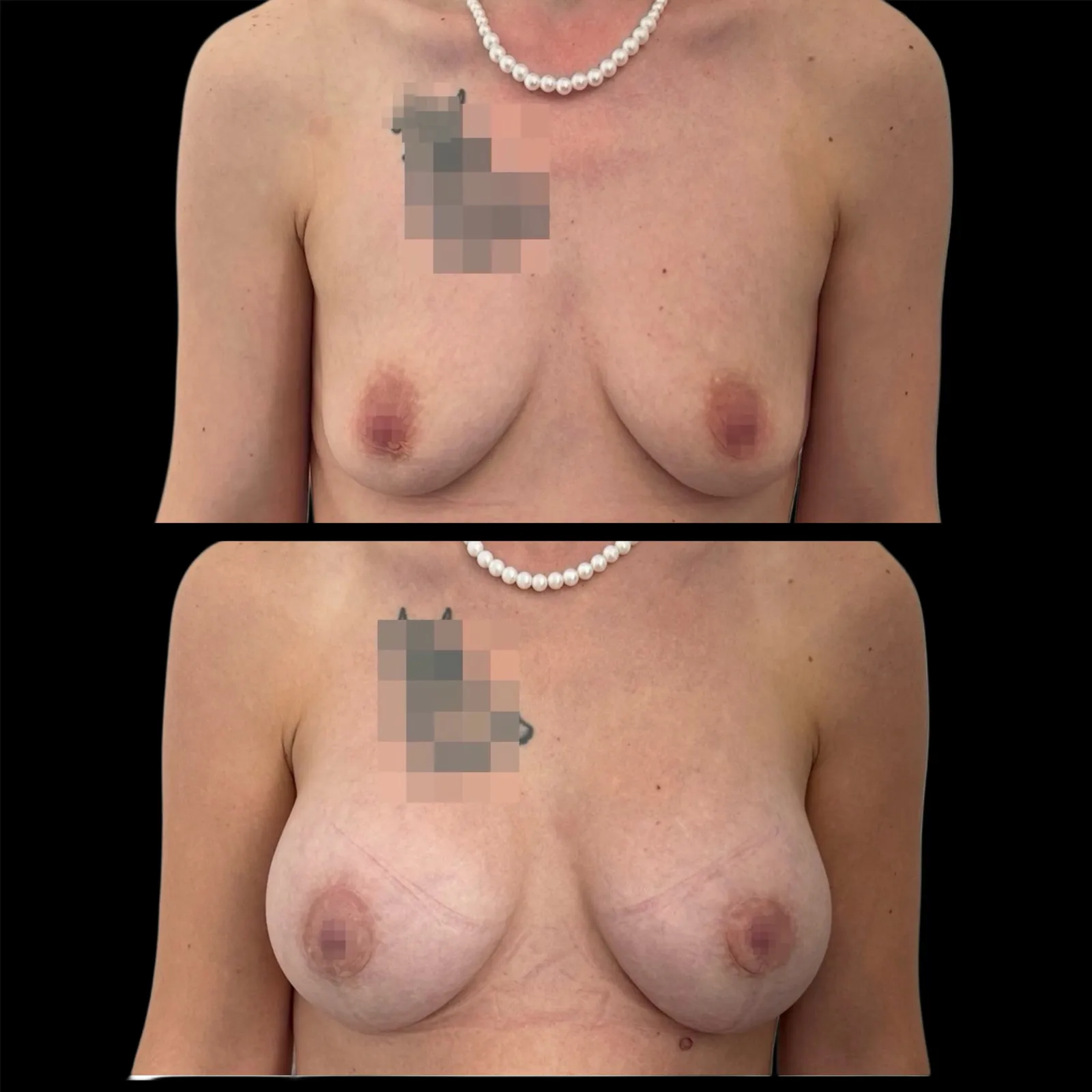Augmentation mammaire par prothèses par le Dr Julie Heranney — avant et après, cliché 17
