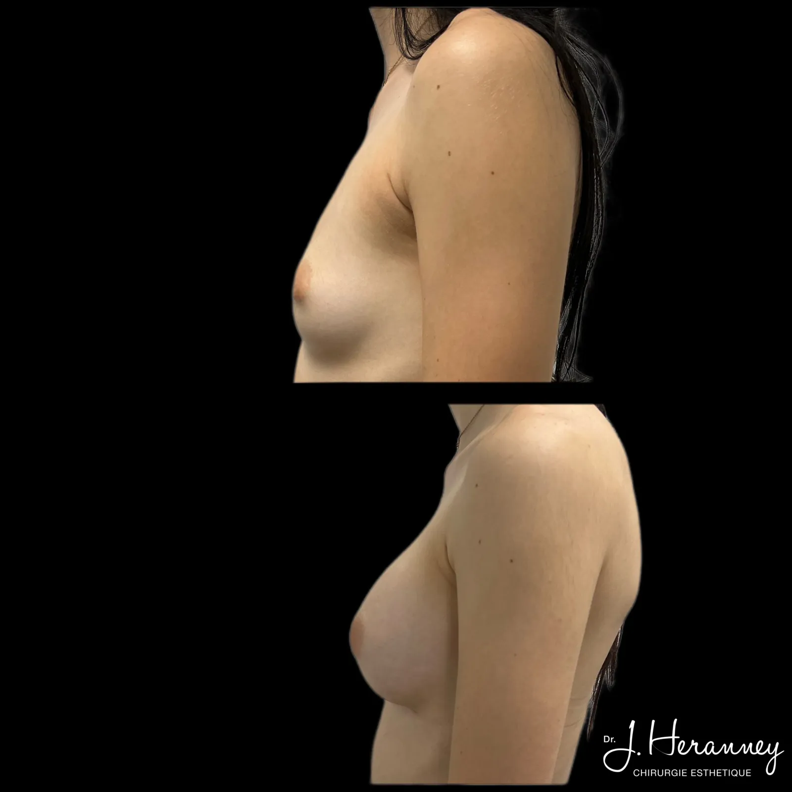 Augmentation mammaire par prothèses par le Dr Julie Heranney — avant et après, cliché 5