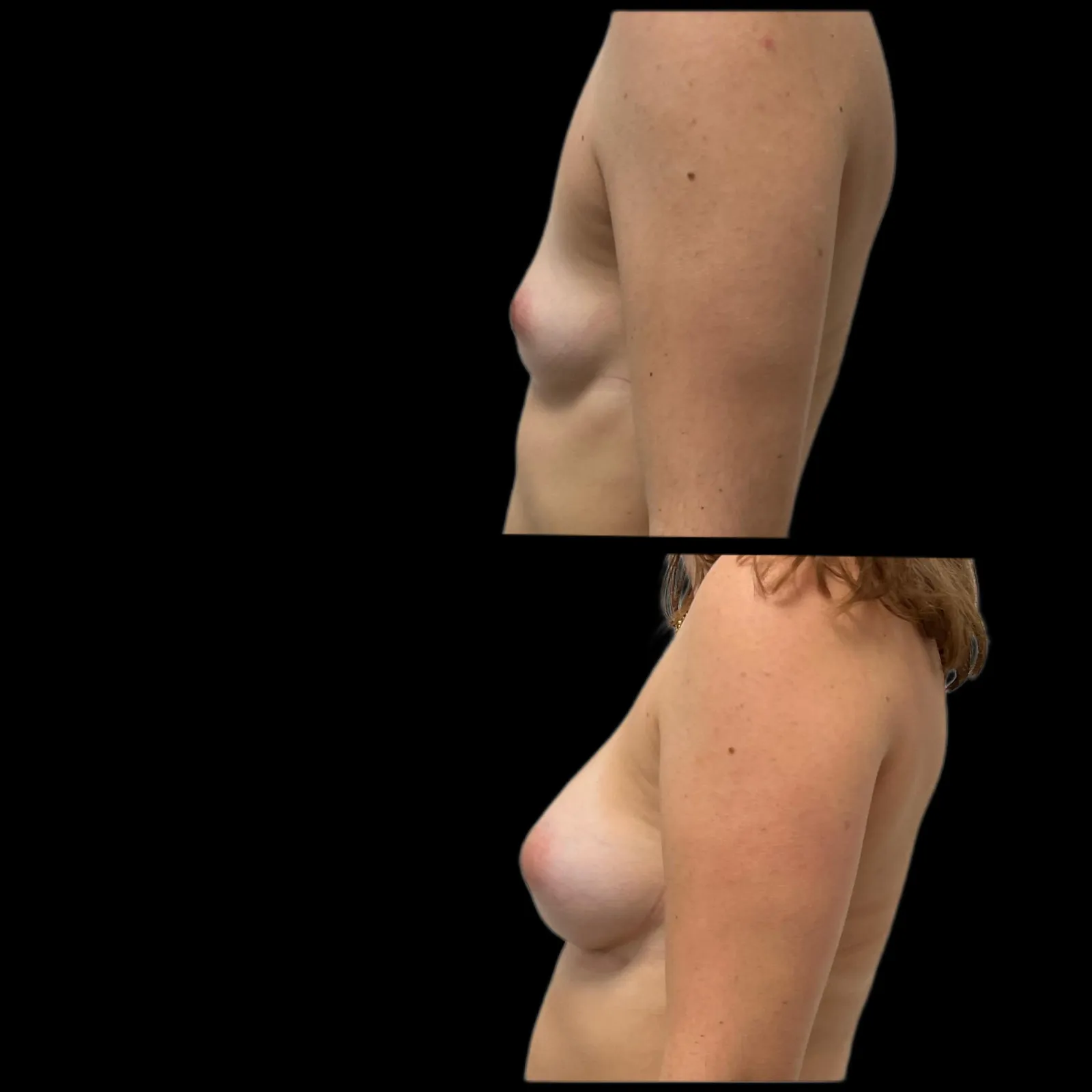 Augmentation mammaire par prothèses par le Dr Julie Heranney — avant et après, cliché 9