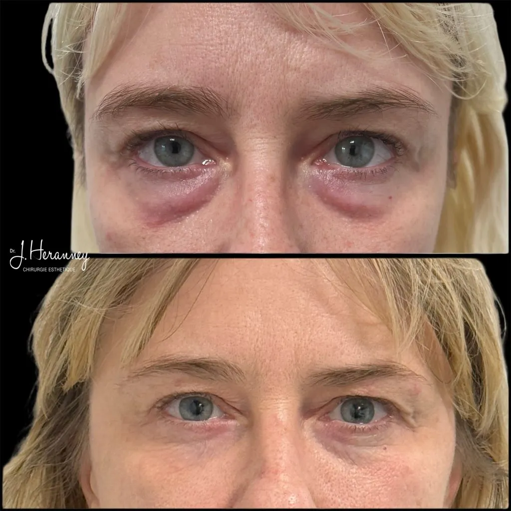 Blépharoplastie par le Dr Julie Heranney — avant et après, cliché 1