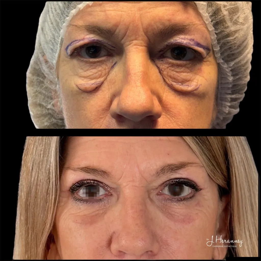 Blépharoplastie par le Dr Julie Heranney — avant et après, cliché 2