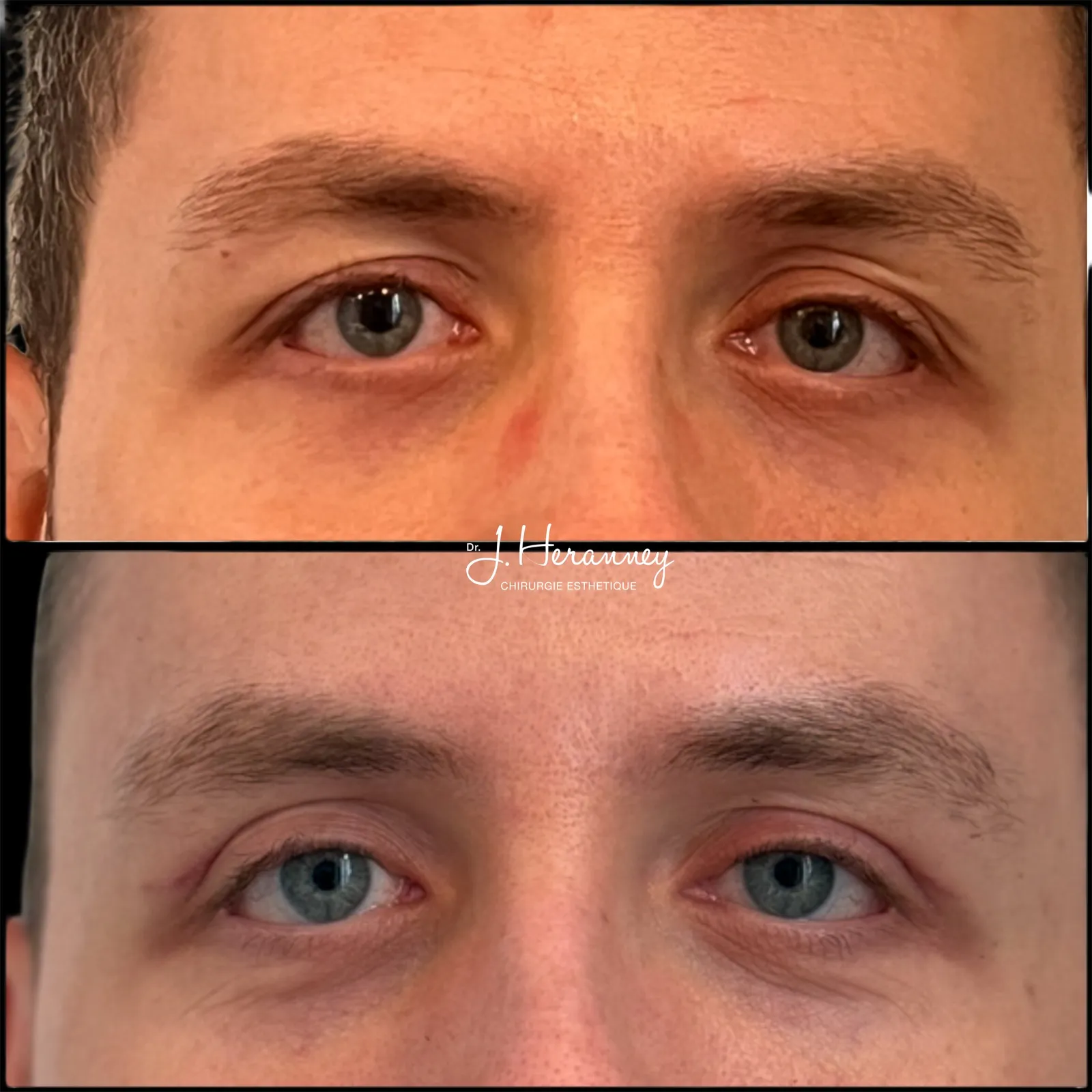 Blépharoplastie de l'homme par le Dr Julie Heranney — avant et après, cliché 1
