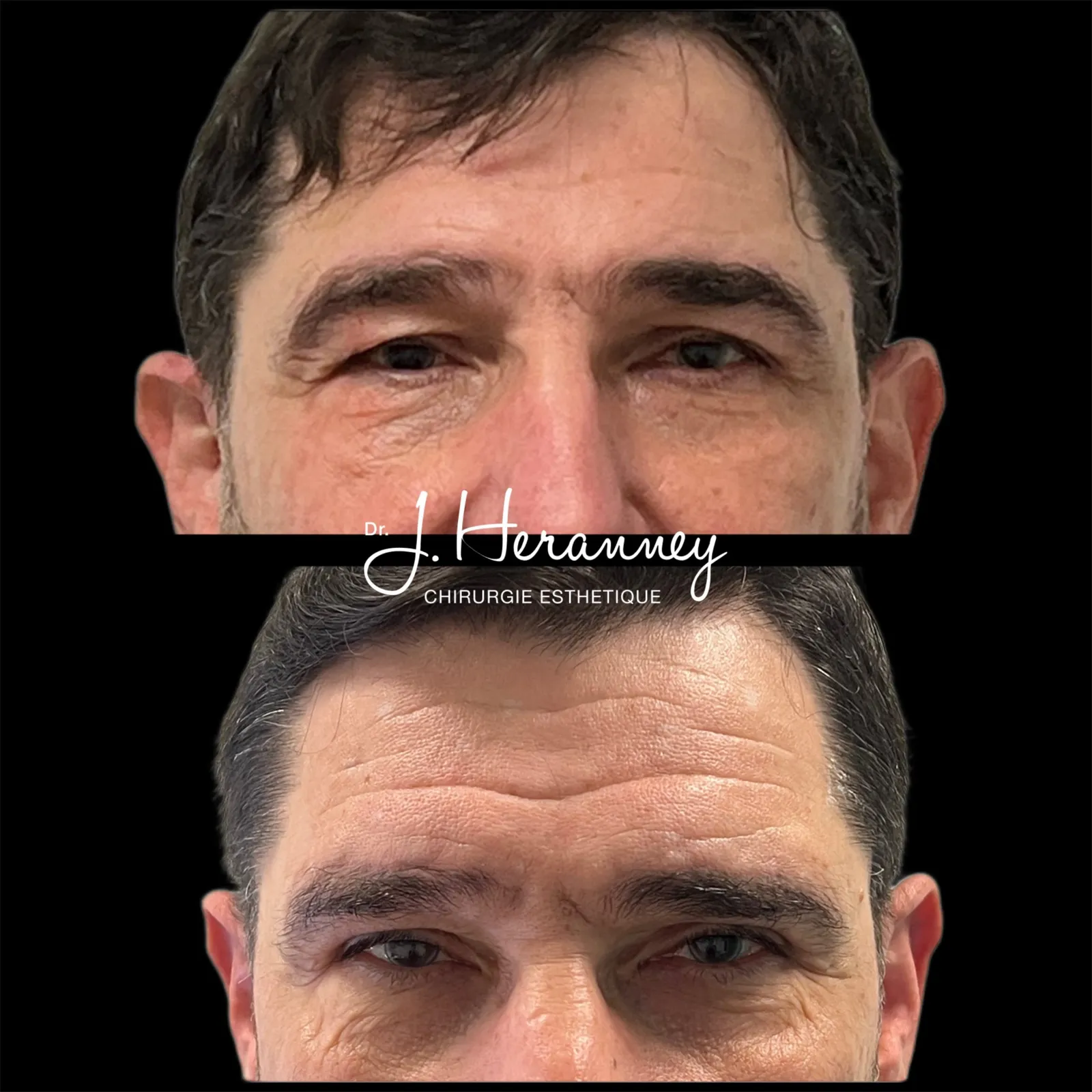 Blépharoplastie de l'homme par le Dr Julie Heranney — avant et après, cliché 2