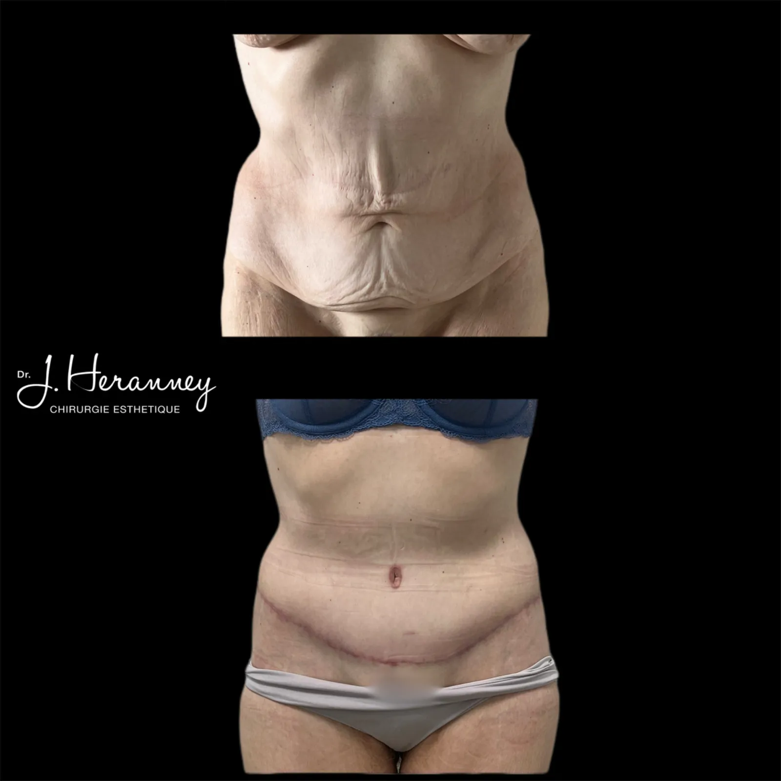 Bodylift par le Dr Julie Heranney — avant et après, cliché 1