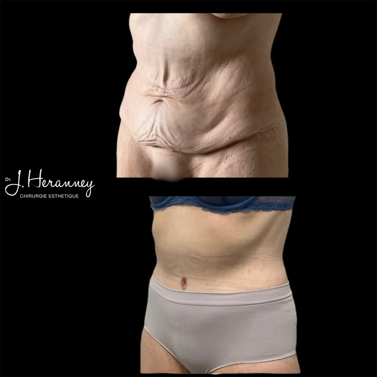 Bodylift par le Dr Julie Heranney — avant et après, cliché 2
