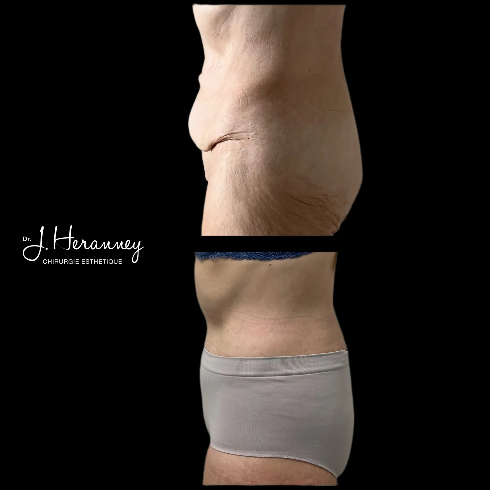 Bodylift par le Dr Julie Heranney — avant et après, cliché 3