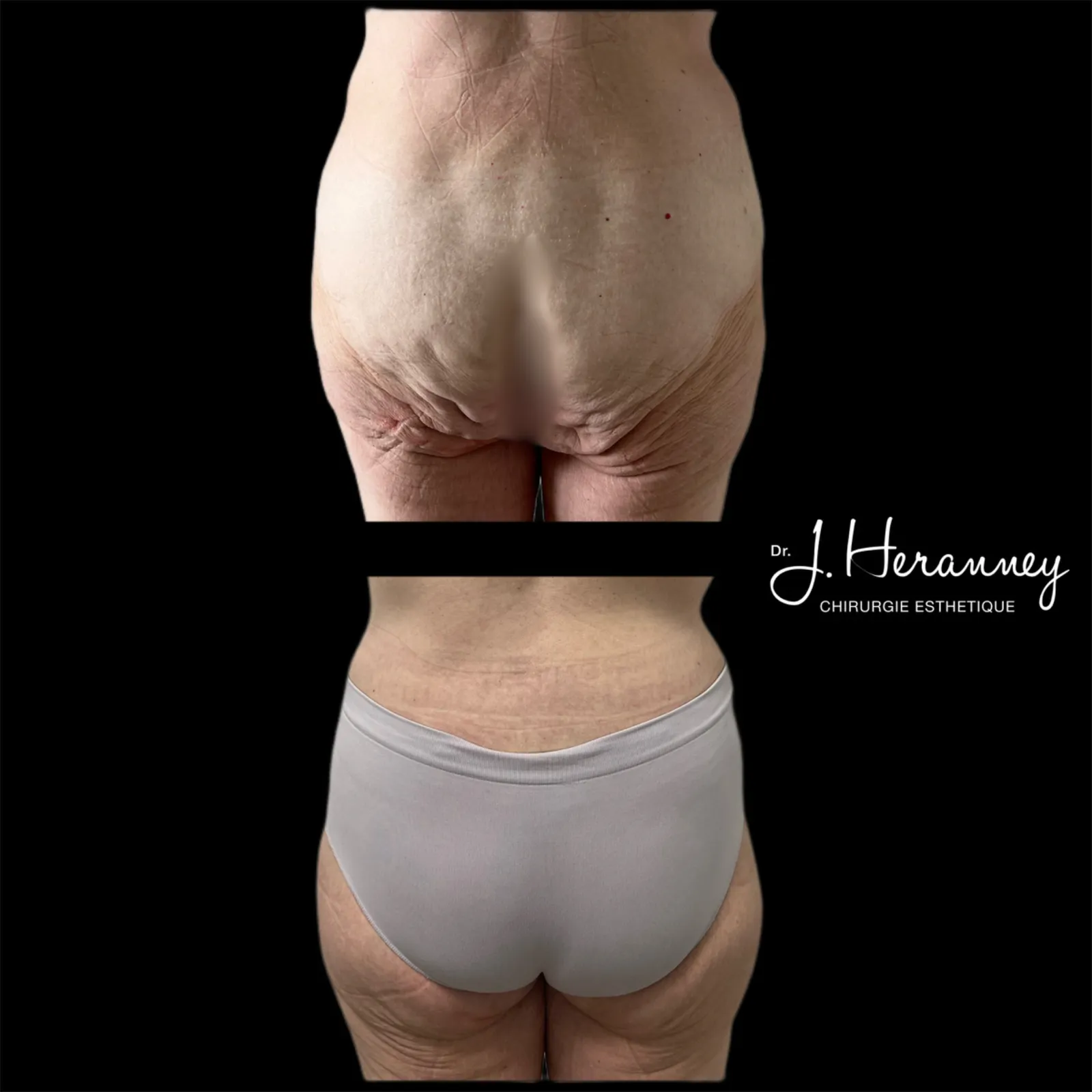 Bodylift par le Dr Julie Heranney — avant et après, cliché 4