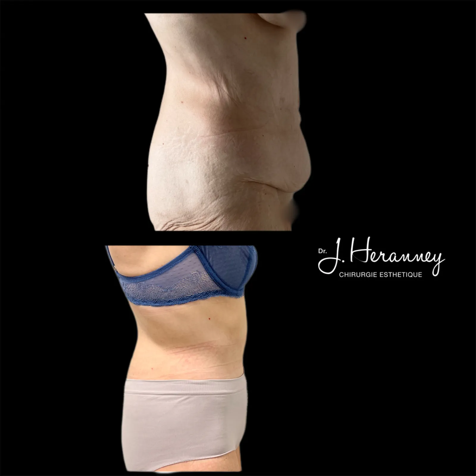 Bodylift par le Dr Julie Heranney — avant et après, cliché 5