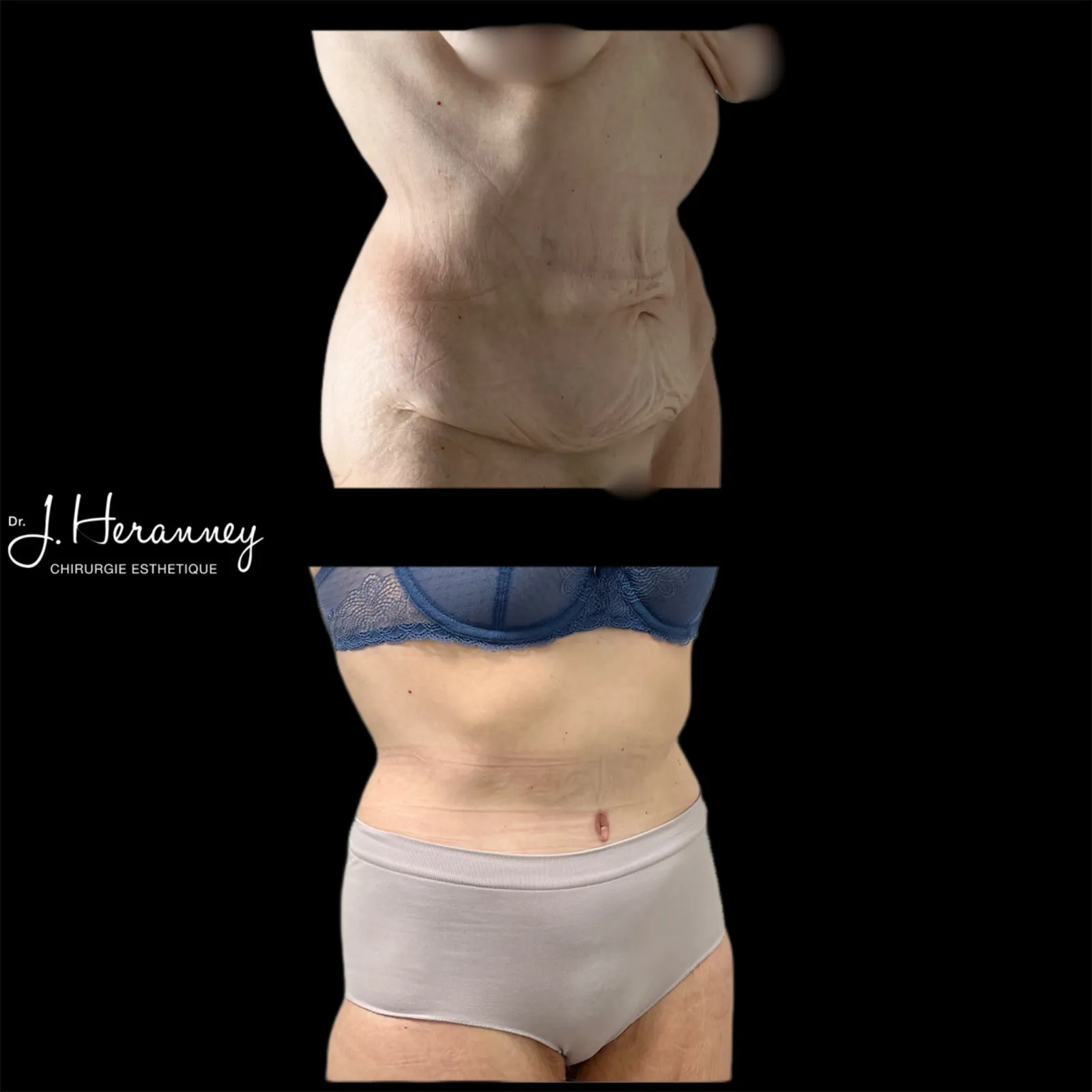 Bodylift par le Dr Julie Heranney — avant et après, cliché 6