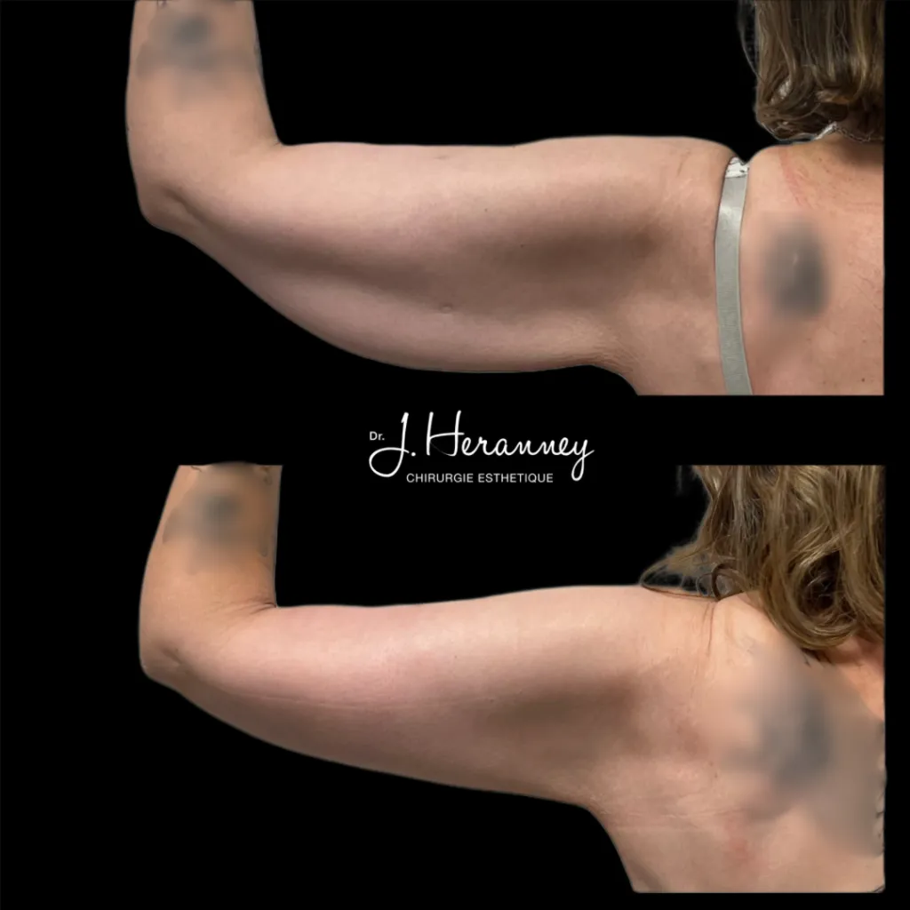 Brachioplastie par le Dr Julie Heranney — avant et après, cliché 1