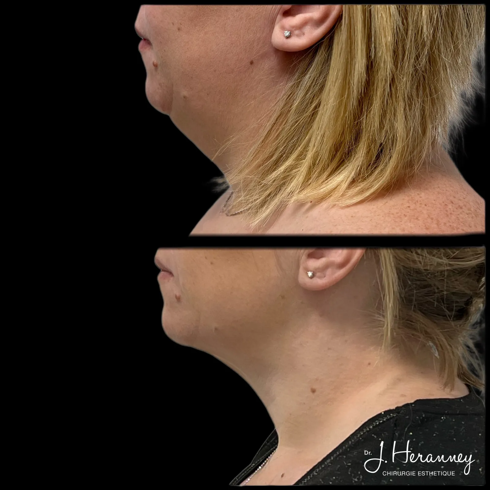 Lifting cervico-facial par le Dr Julie Heranney — avant et après, cliché 1