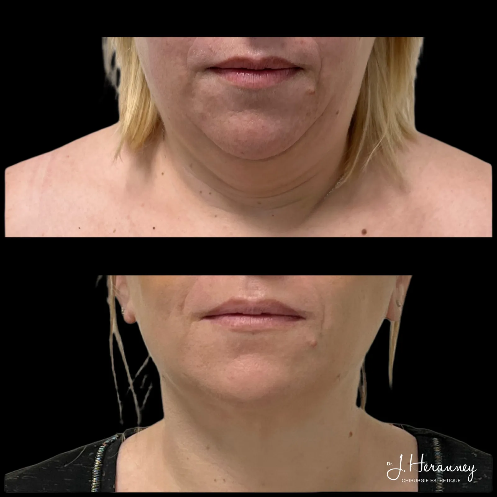 Lifting cervico-facial par le Dr Julie Heranney — avant et après, cliché 2
