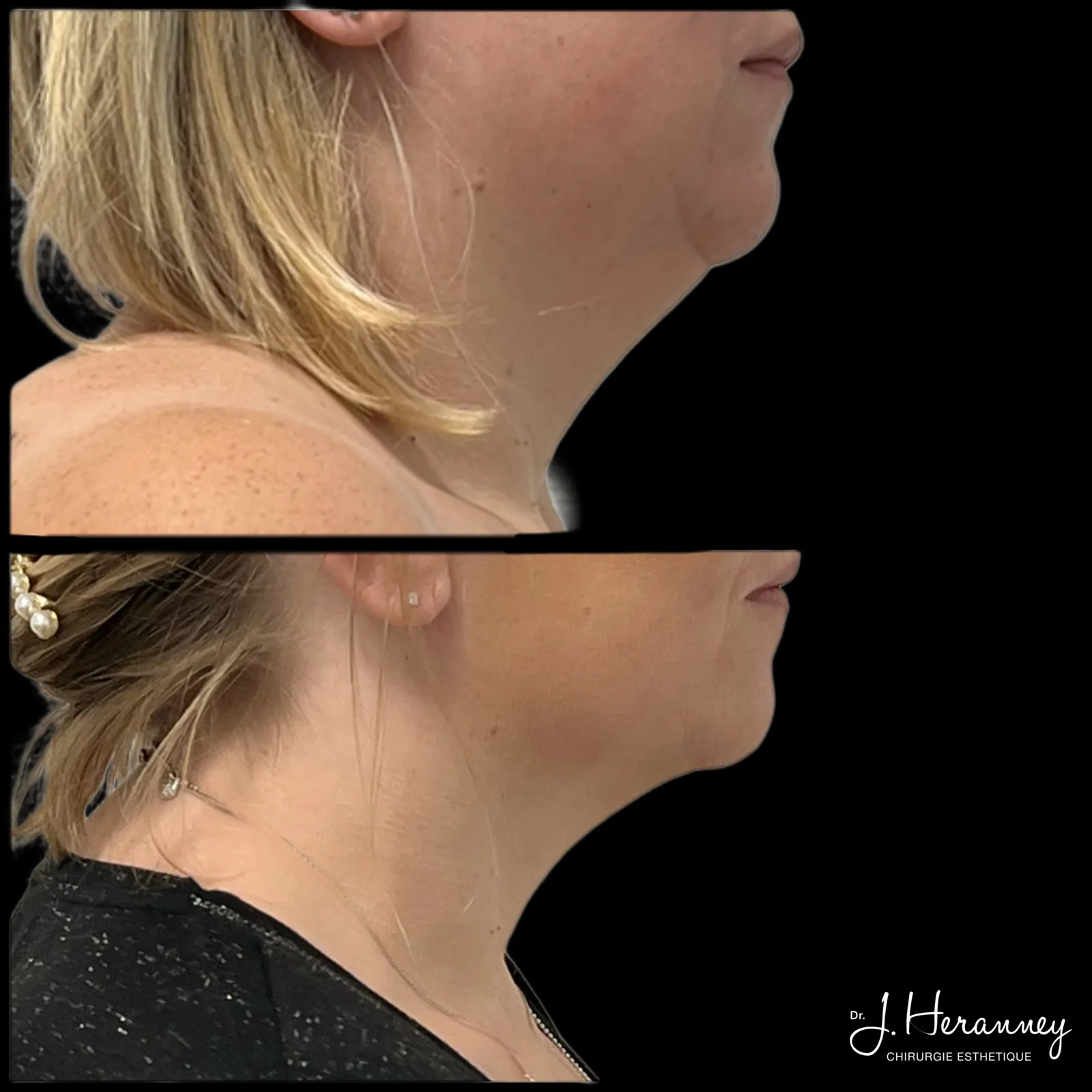 Lifting cervico-facial par le Dr Julie Heranney — avant et après, cliché 3