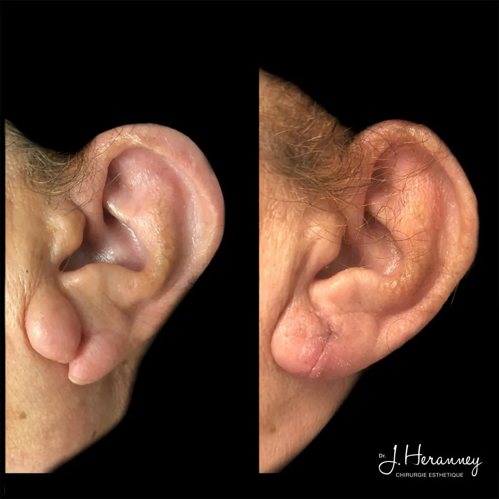 Lobe fendu par le Dr Julie Heranney — avant et après, cliché 1