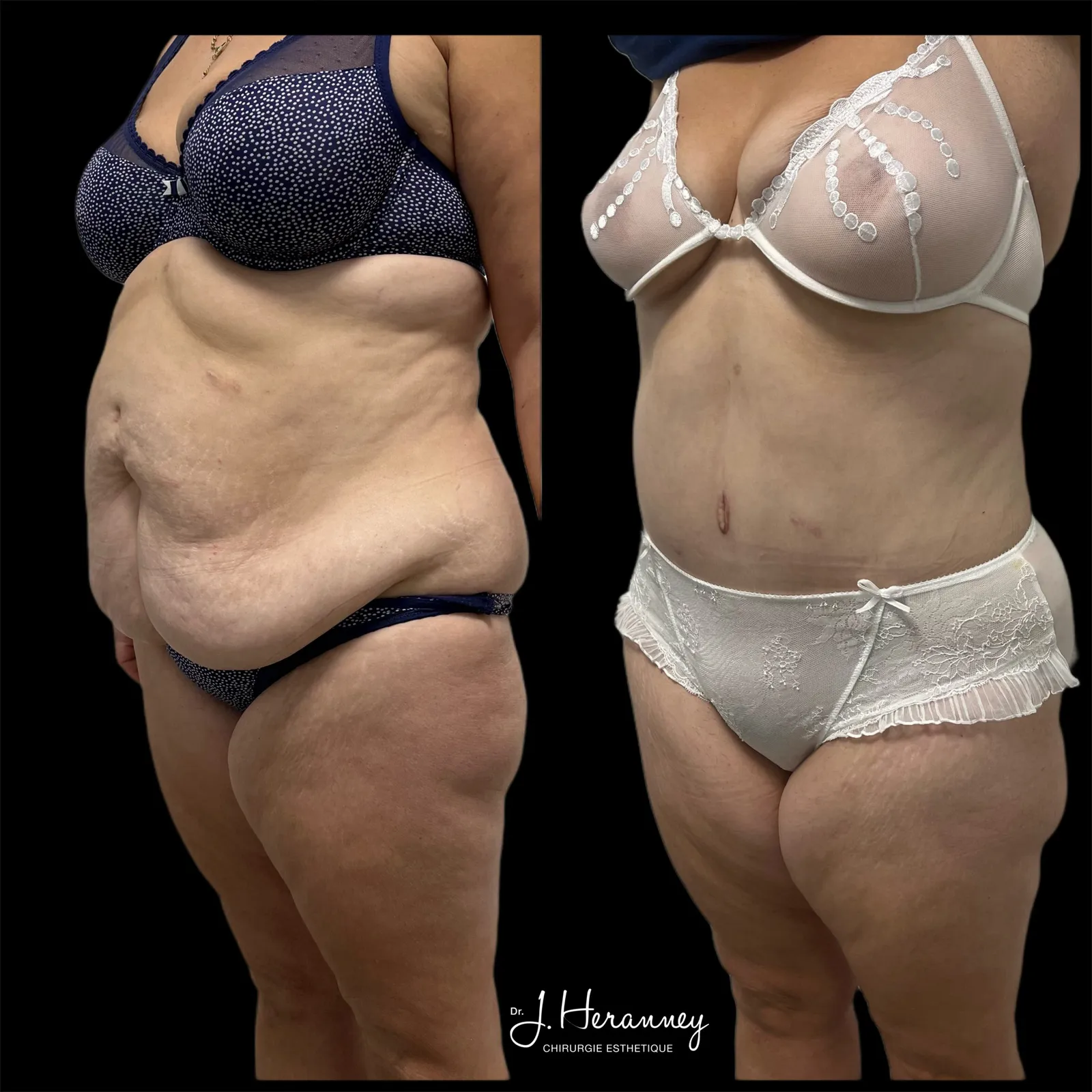 Plastie abdominale par le Dr Julie Heranney — avant et après, cliché 1