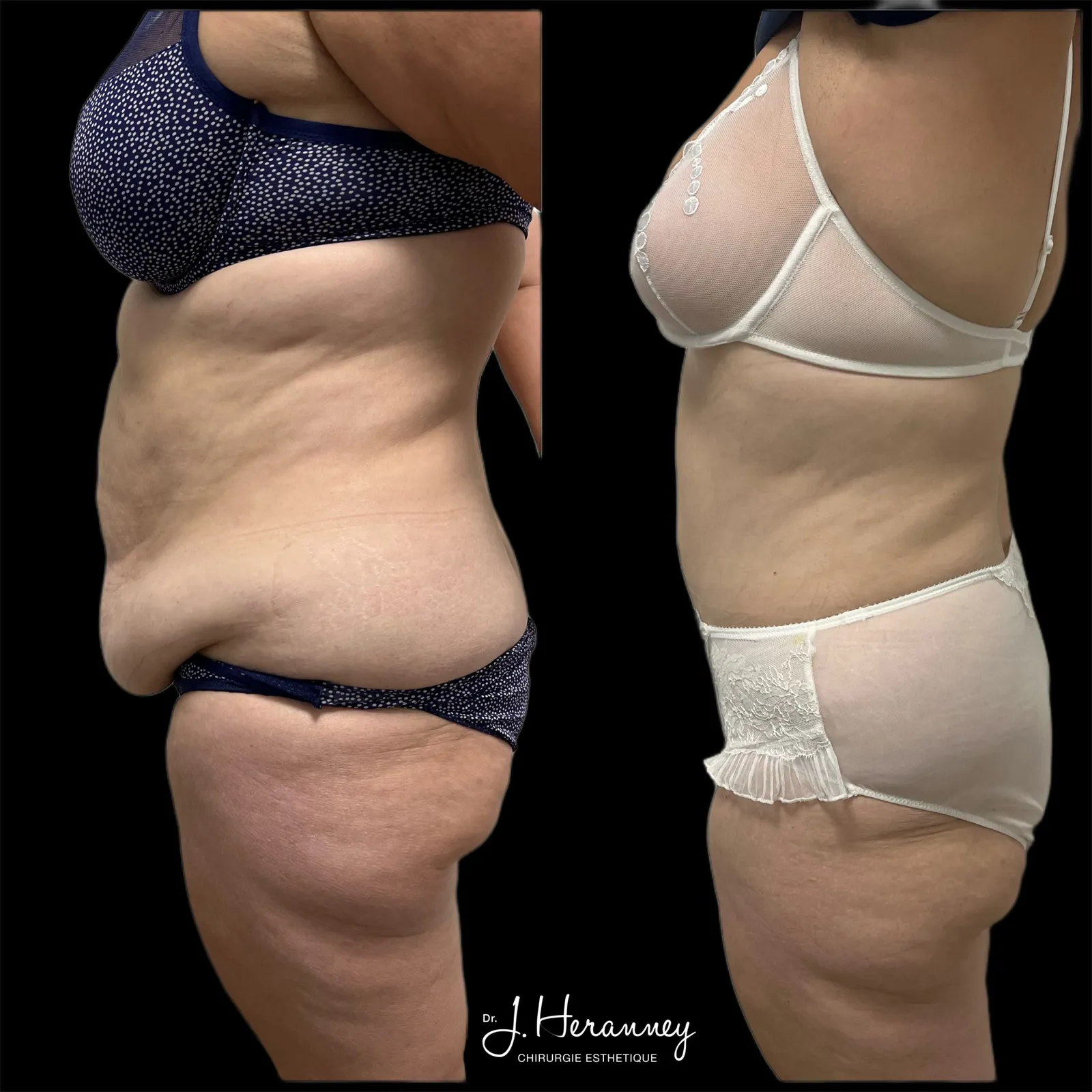 Plastie abdominale par le Dr Julie Heranney — avant et après, cliché 2