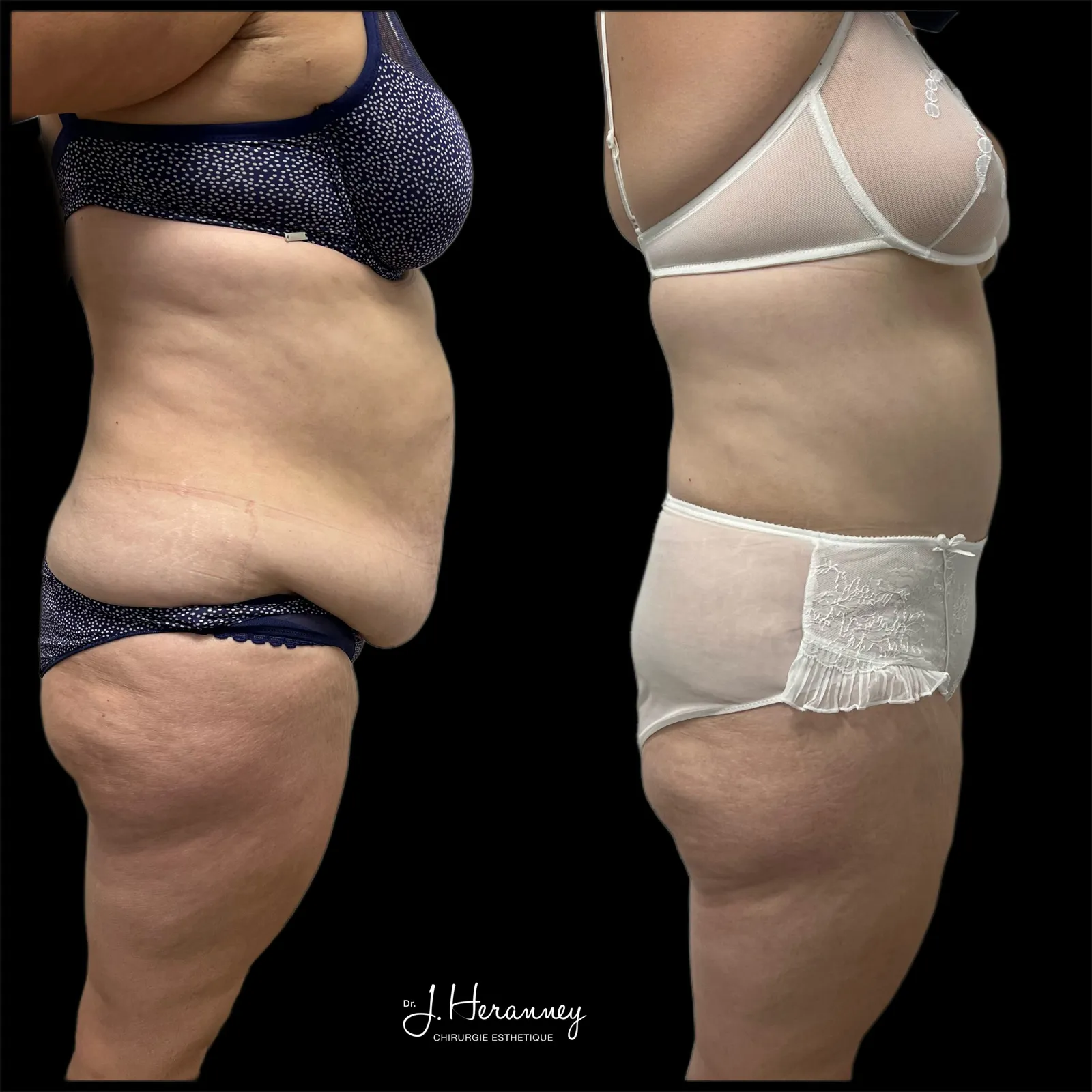 Plastie abdominale par le Dr Julie Heranney — avant et après, cliché 3