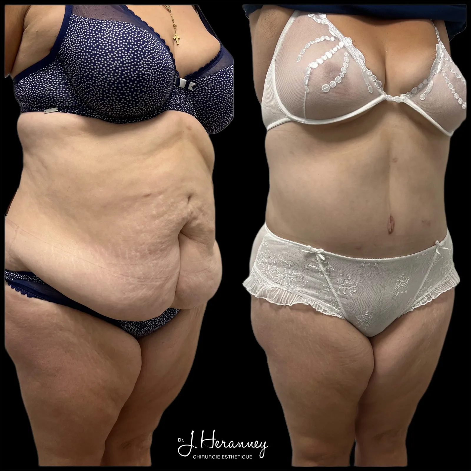 Plastie abdominale par le Dr Julie Heranney — avant et après, cliché 4