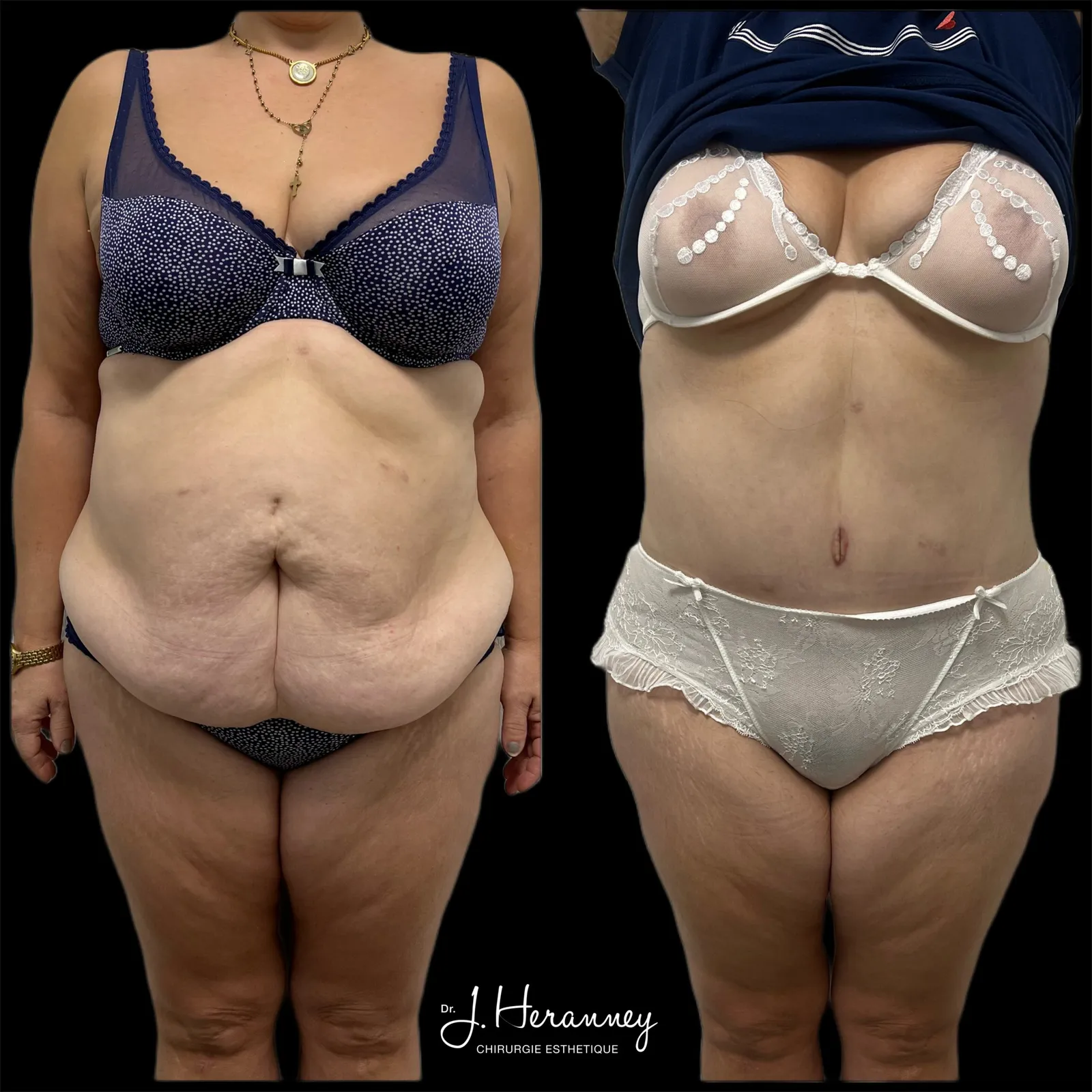 Plastie abdominale par le Dr Julie Heranney — avant et après, cliché 5