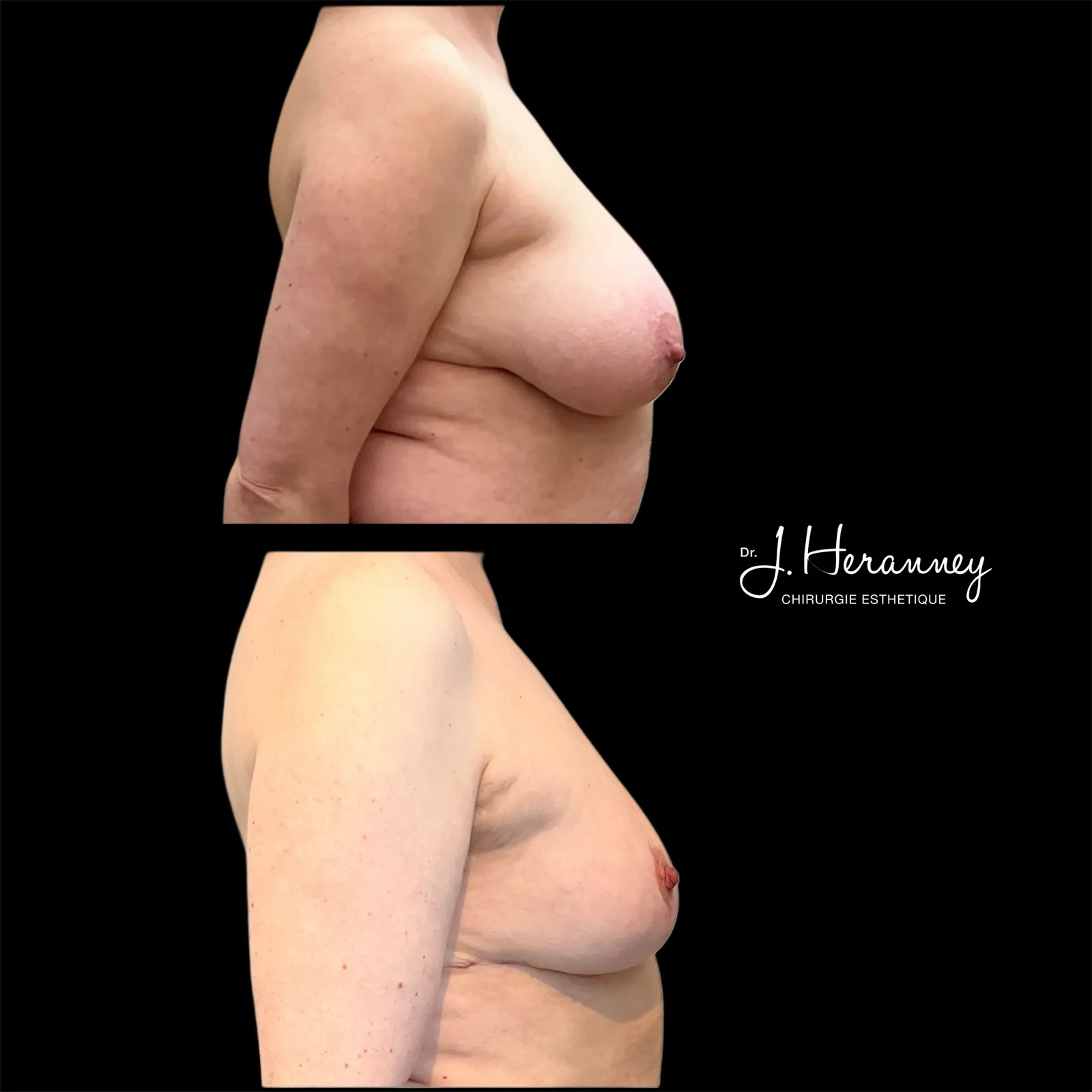 Réduction mammaire par le Dr Julie Heranney — avant et après, cliché 8
