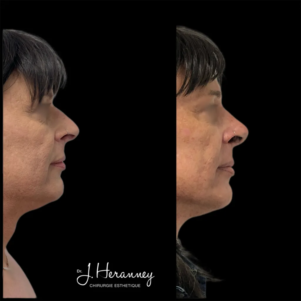 Rhinoplastie par le Dr Julie Heranney — avant et après, cliché 1
