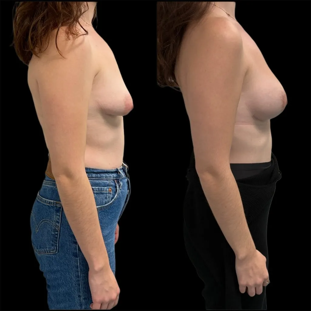 Seins tubéreux par le Dr Julie Heranney — avant et après, cliché 1