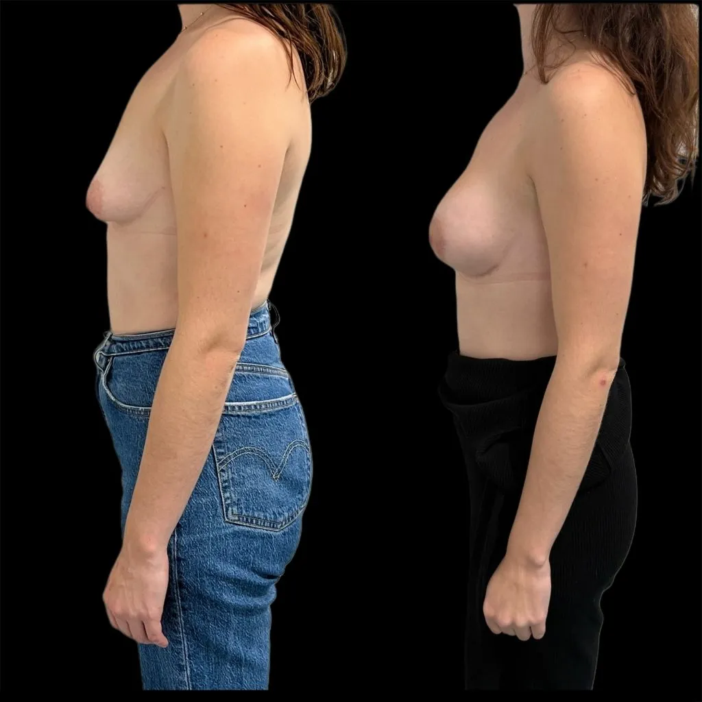 Seins tubéreux par le Dr Julie Heranney — avant et après, cliché 3