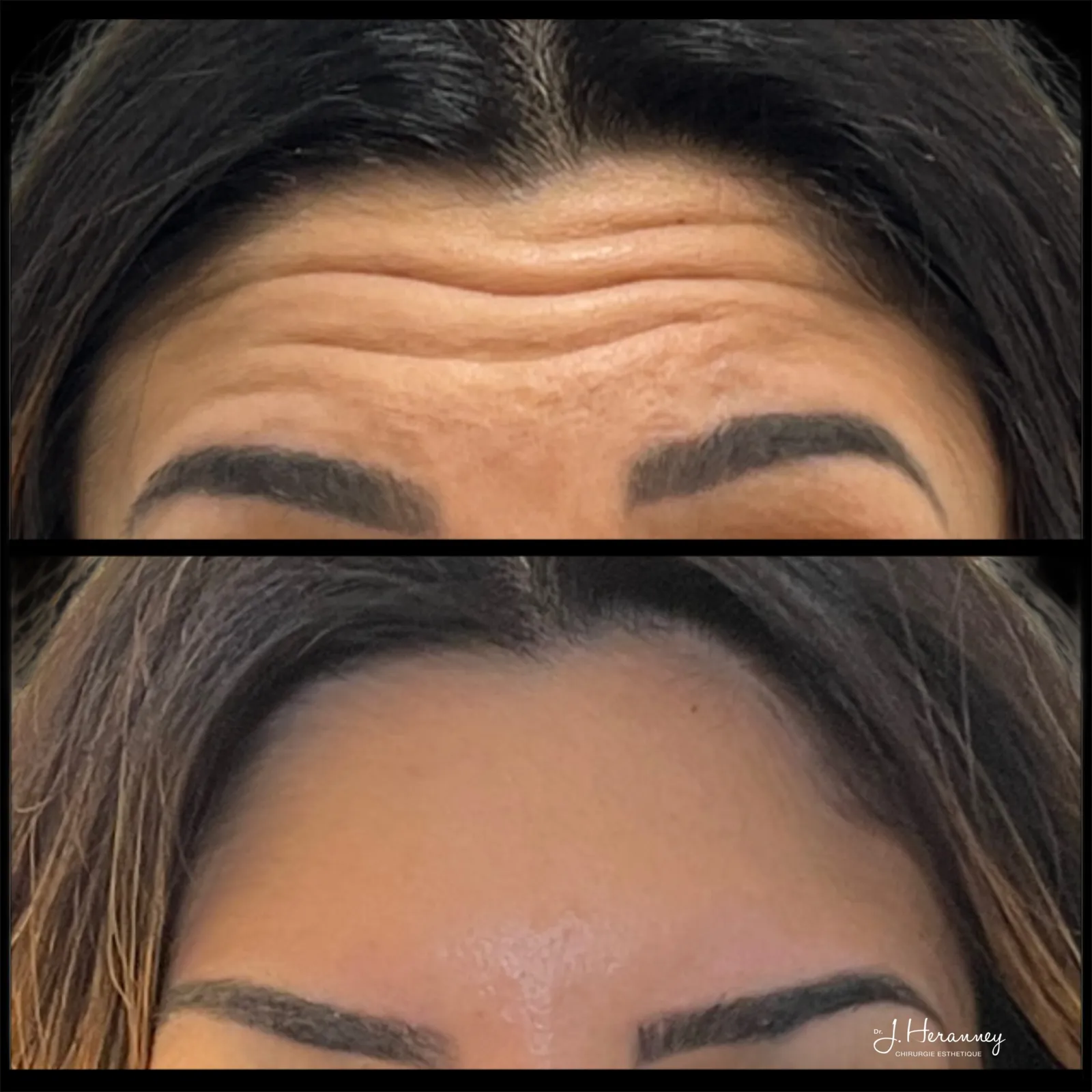 Toxine botulique (Botox) par le Dr Julie Heranney — avant et après, cliché 1