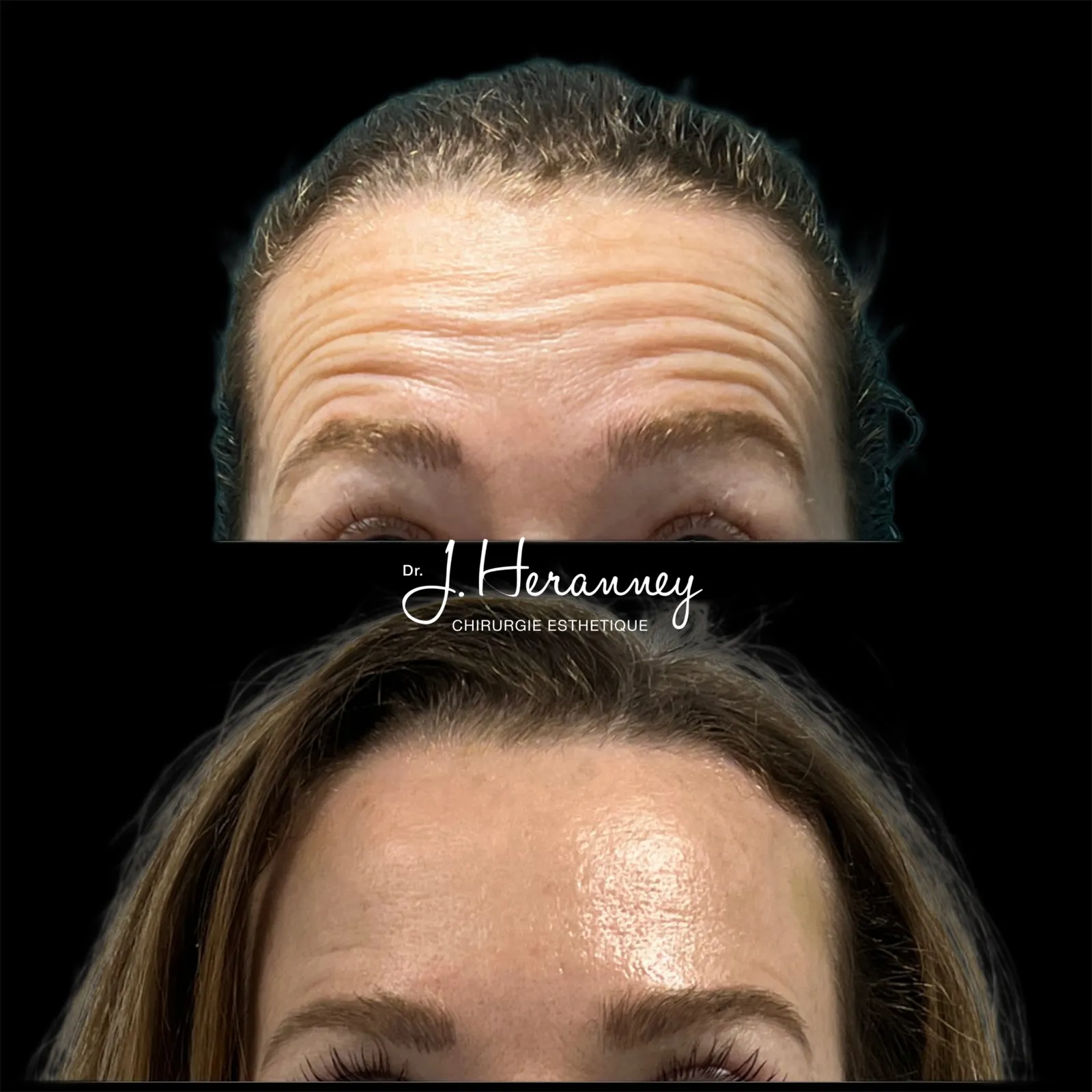 Toxine botulique (Botox) par le Dr Julie Heranney — avant et après, cliché 2