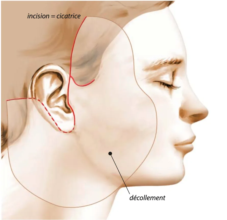 Schéma du tracé de l'incision d'un lifting cervico-facial, autour de l'oreille, et de la zone de décollement