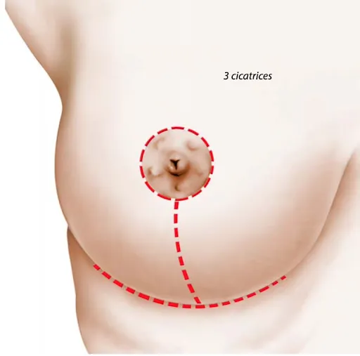 Schéma des trois cicatrices d'une réduction mammaire : autour de l'aréole, verticale et horizontale dans le sillon sous-mammaire