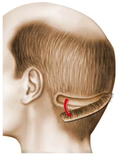 Schéma de la couronne hippocratique, zone donneuse de cheveux située à l'arrière du crâne