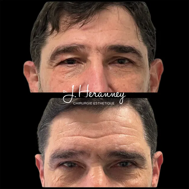 Blépharoplastie de l'homme par le Dr Julie Heranney — avant et après, cliché 2