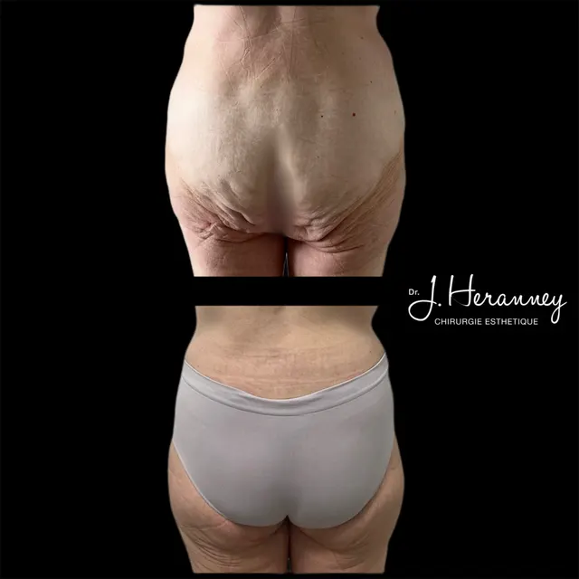 Bodylift par le Dr Julie Heranney — avant et après, cliché 4