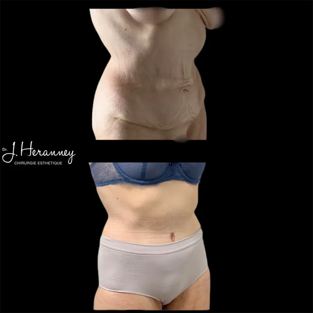 Bodylift par le Dr Julie Heranney — avant et après, cliché 6