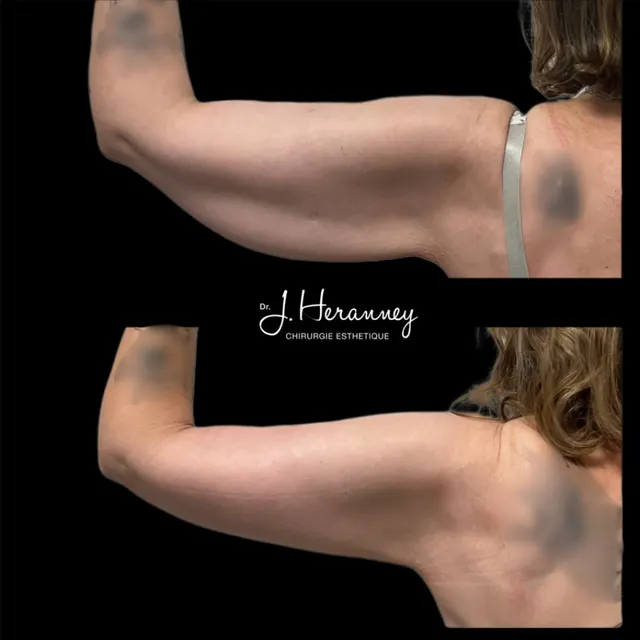 Brachioplastie par le Dr Julie Heranney — avant et après, cliché 1