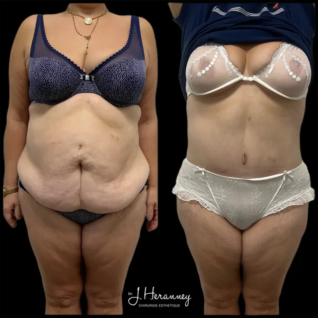 Plastie abdominale par le Dr Julie Heranney — avant et après, cliché 5