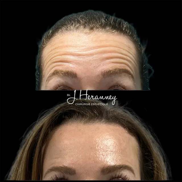 Toxine botulique (Botox) par le Dr Julie Heranney — avant et après, cliché 2
