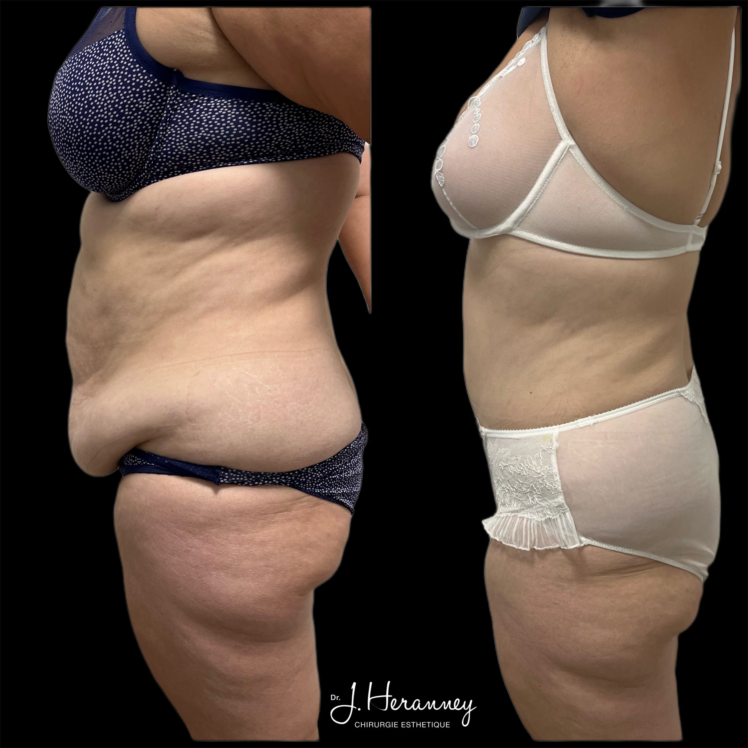 PHOTO plastie abdominale 3