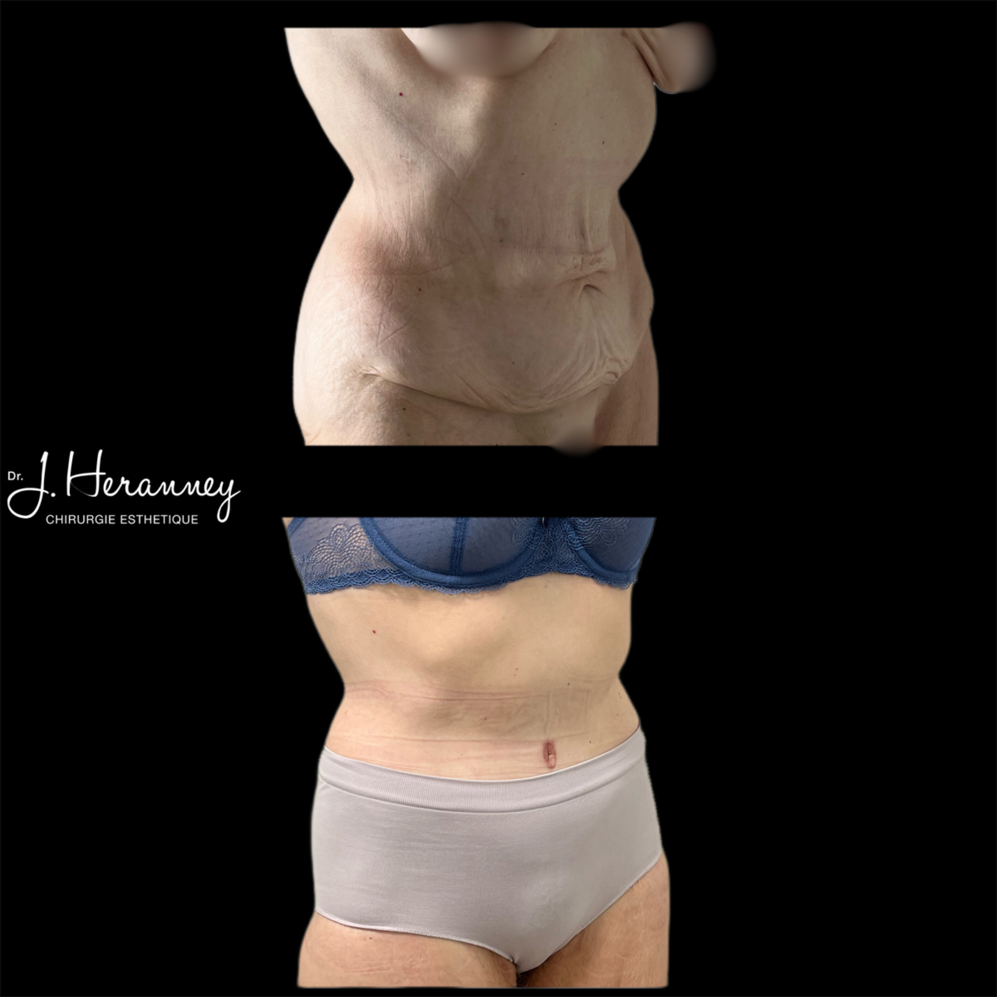 bodylift 34 droit