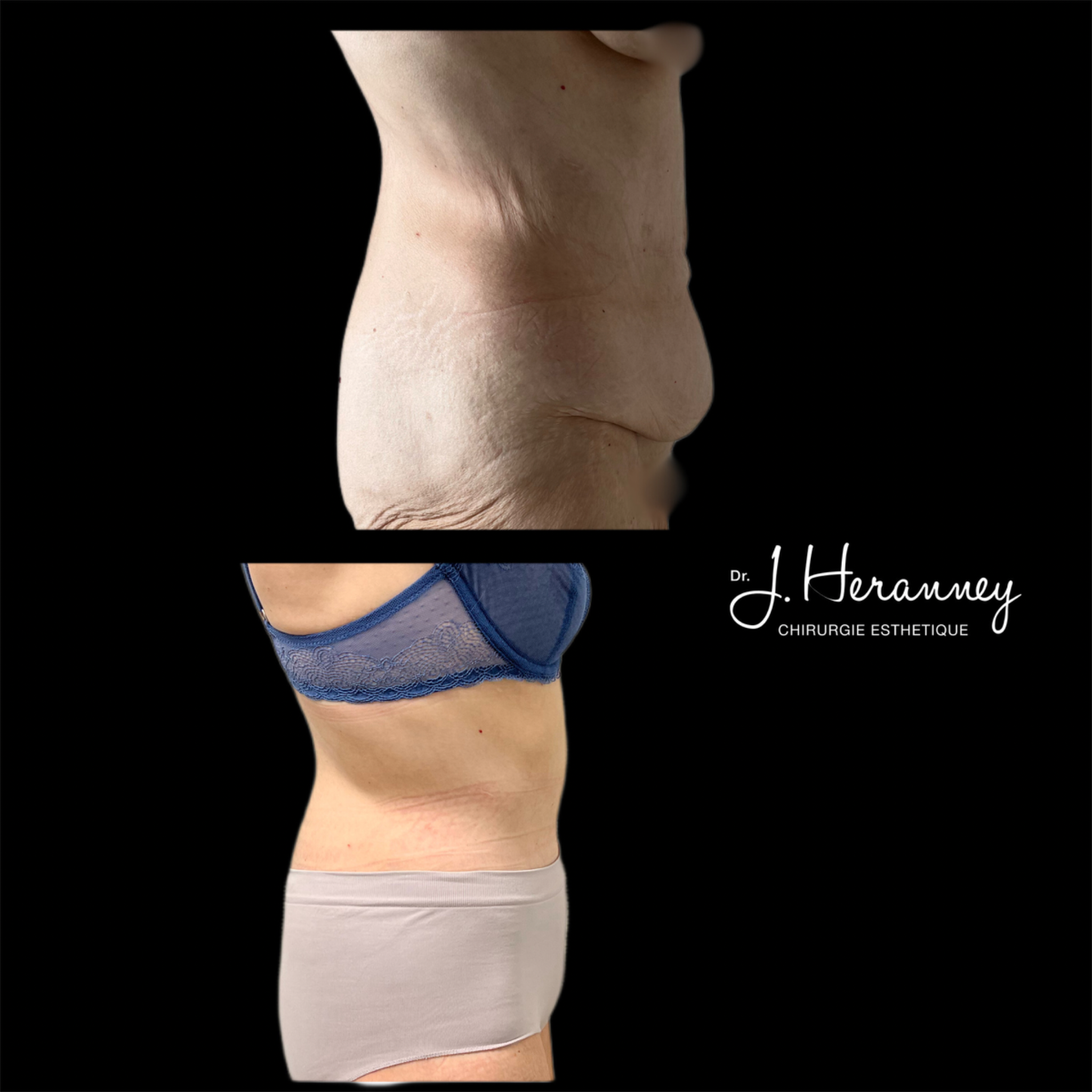 bodylift profil droit